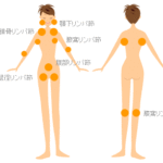 癌転移検査とセンチネルリンパ節シンチグラフィーの仕組みと役割