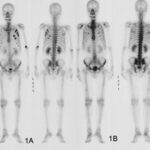 乳がんや肺がんの骨転移を見つけ出す骨シンチ検査のしくみと検査前に気をつけること