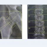 【骨密度って何？】骨塩定量検査の仕組みと骨がもろくなる骨粗鬆症をわかりやすく解説