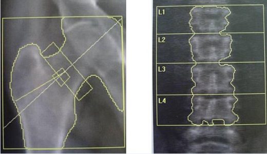 【骨の健康チェック！】骨密度検査の仕組みと種類、検査費用を解説