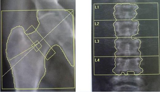 【骨密度って何？】骨塩定量検査の仕組みと骨がもろくなる骨粗鬆症をわかりやすく解説