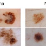 なぜそっくり？メラノーマとほくろが似ているわけ