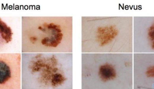 なぜそっくり？メラノーマとほくろが似ているわけ