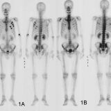 骨シンチの検査方法は？仕組みや費用、検査時間なども詳しく紹介