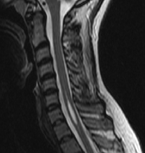 【キアリ奇形・脊髄空洞症とは？】発見から手術までの体験記と現在の状態